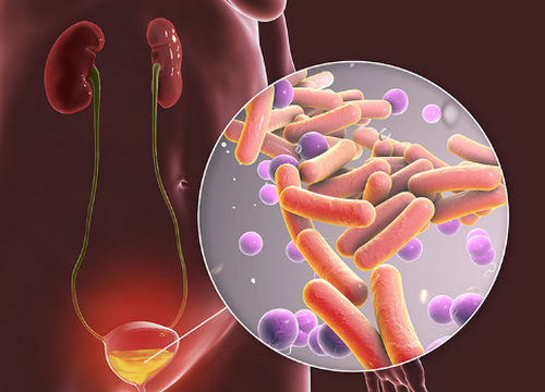 Bệnh viêm đường tiết niệu là gì? Nguyên nhân, dấu hiệu và cách điều trị