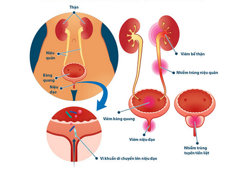 Bệnh viêm đường tiết niệu là gì? Nguyên nhân, dấu hiệu và cách điều trị