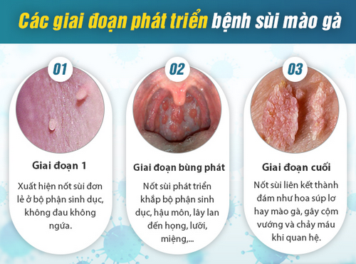 Dấu hiệu/ biểu hiện/ triệu chứng sùi mào gà mà bạn không nên xem thường