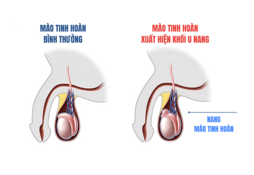 Đau tinh hoàn 1-2 bên là bị làm sao? Cách điều trị an toàn