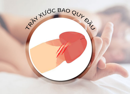 Dương vật bị trầy xước là thế nào? Có phải là bệnh không