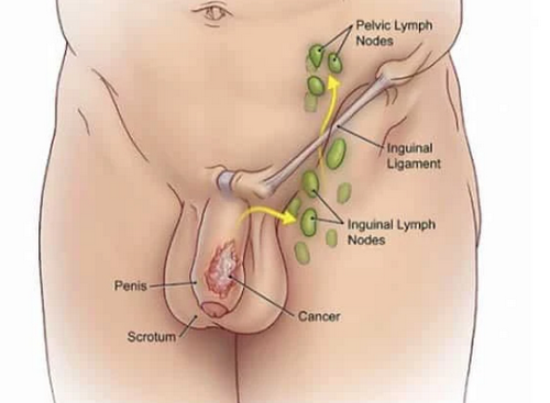 Dương vật nổi hạch: Nguyên nhân, dấu hiệu và cách điều trị