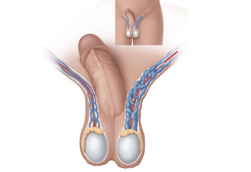 Giãn tĩnh mạch thừng tinh: Nguyên nhân, dấu hiệu và cách chữa trị