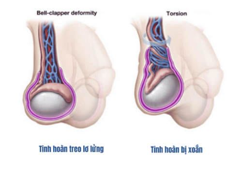 Hiện tượng đau tinh hoàn bên trái: Nguyên nhân và cách chữa trị