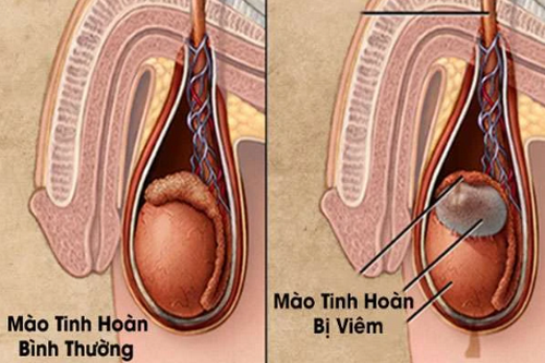 Hiện tượng đau tinh hoàn bên trái: Nguyên nhân và cách chữa trị