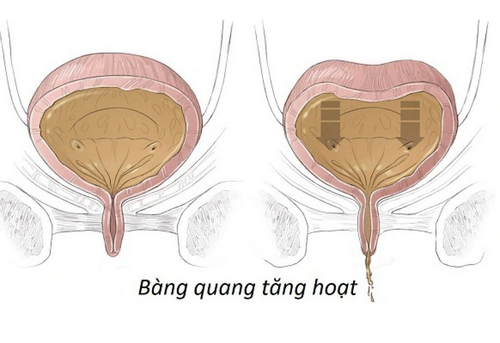 Mắc tiểu không tự chủ là như thế nào? Dấu hiệu nhận biết và cách điều trị