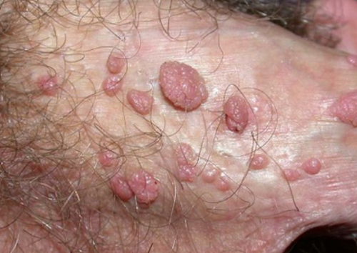 Mụn cóc sinh dục HPV mọc ở đâu? Cách điều trị hiệu quả