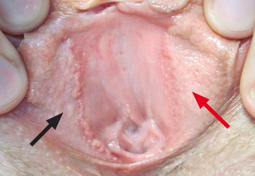 Mụn gai sinh dục là gì, dấu hiệu nhận biết và cách điều trị