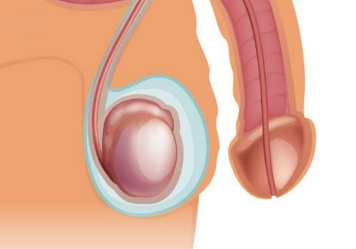 Nam giới bị viêm tinh hoàn có quan hệ được không? Chuyên gia tư vấn