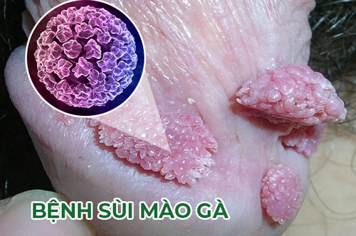 Nốt sùi mào gà thường mọc ở đâu, các dấu hiệu nhận biết sùi