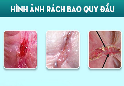 Rách bao quy đầu: Nguyên nhân, dấu hiệu và cách điều trị