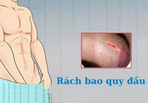 Rách bao quy đầu: Nguyên nhân, dấu hiệu và cách điều trị