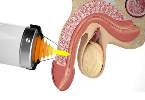 Rối loạn cương dương: Nguyên nhân, dấu hiệu và cách điều trị