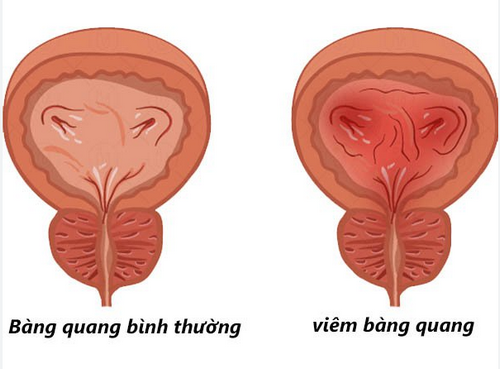 Tiểu buốt có tự hết không? Cần thăm khám gì và khi nào?