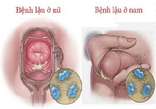 Tiểu buốt ra dịch mủ: Nguyên nhân, dấu hiệu và cách điều trị hiệu quả