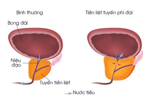 Tiểu buốt tiểu rắt có phải là bệnh không? Bệnh gì?