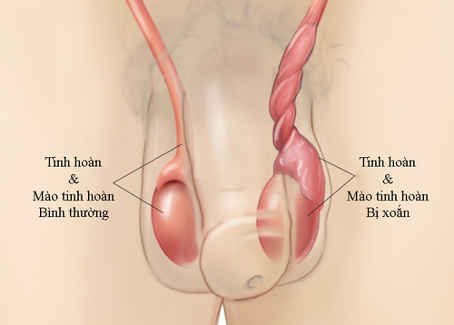 Tinh hoàn bên to bên nhỏ: Nguyên nhân, dấu hiệu và cách điều trị