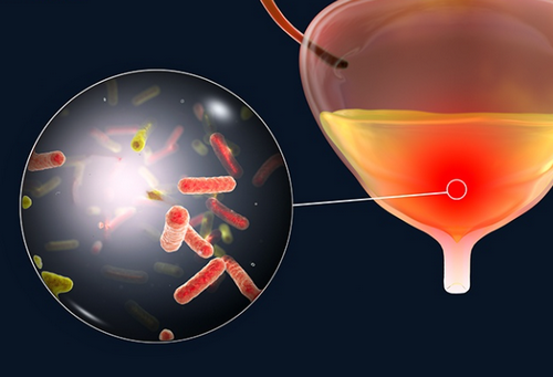 Viêm bàng quang: Nguyên nhân, dấu hiệu và cách chữa trị hiệu quả