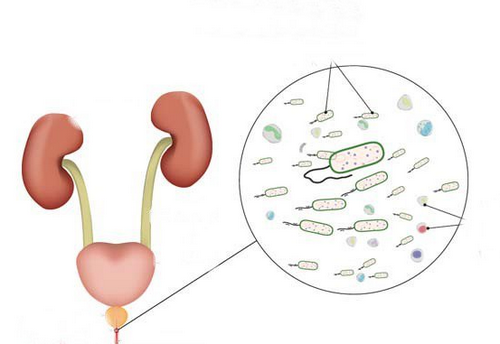 Viêm niệu đạo: Nguyên nhân, dấu hiệu và cách điều trị hiệu quả