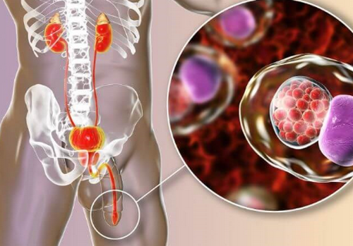 Viêm niệu đạo: Nguyên nhân, dấu hiệu và cách điều trị hiệu quả