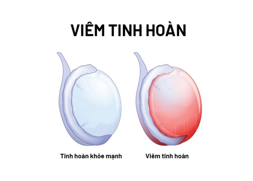 Viêm tinh hoàn: Nguyên nhân, dấu hiệu và cách điều trị hiệu quả