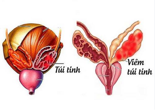 Viêm túi tinh: Nguyên nhân, dấu hiệu và cách điều trị hiệu quả