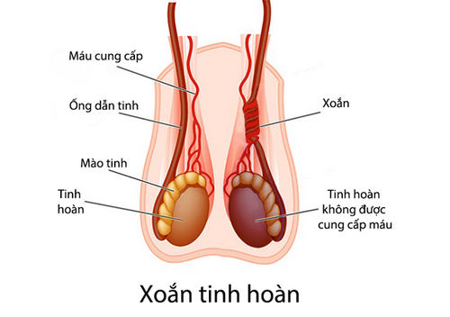 Xoắn tinh hoàn: Nguyên nhân, dấu hiệu và cách chữa trị an toàn