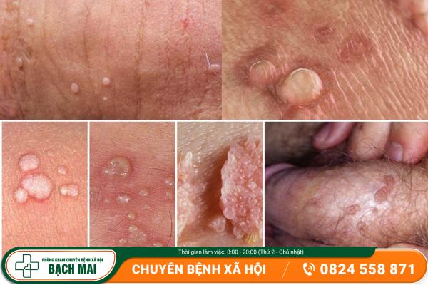 Nổi mụn sinh dục dương vật – Triệu chứng đầu tiên của bệnh xã hội? 8