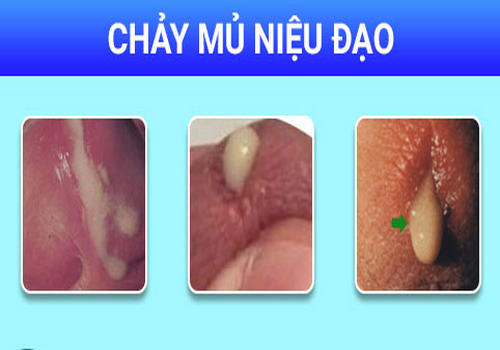 Chảy mủ ở bao quy đầu là mắc bệnh gì? Có phải lậu không?