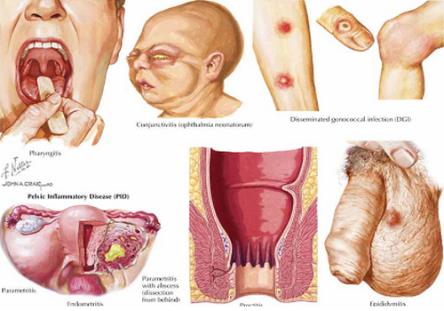 Đái dắt đái ra mủ là như thế nào? Có liên quan đến bệnh gì?