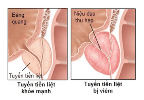 Đi tiểu buốt rát, tiểu rắt có mủ là bị bệnh gì? Chuyên gia chỉ sẻ