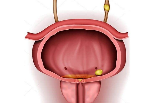 Hiện tượng tiểu buốt đau bụng dưới ở cánh mày râu