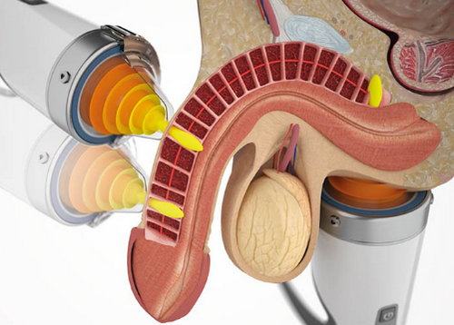 Nam giới bị xuất tinh sớm phải làm sao để cải thiện hiệu quả