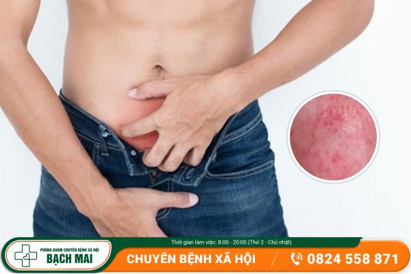Mụn nhọt sinh dục và những tác hại nguy hiểm 7