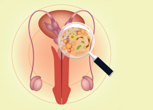 Nguyên nhân viêm tuyến tiền liệt dễ gặp phải là gì?