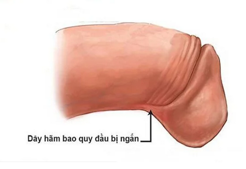 Phẫu thuật tạo hình dây hãm bao quy đầu khi nào? Ở đâu hiệu quả