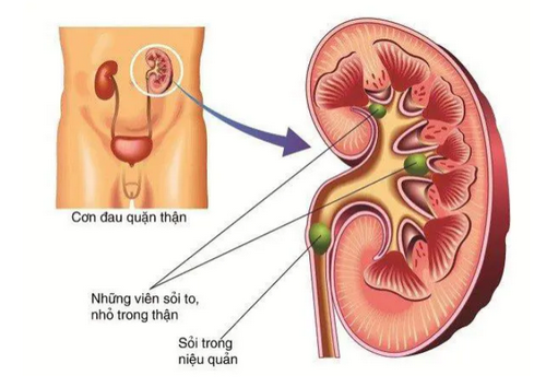 Tắc nghẽn đường tiết niệu: Nguyên nhân, dấu hiệu và cách điều trị