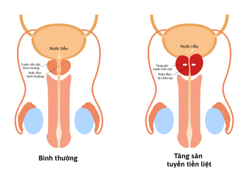 Tăng sản (tăng sinh) tuyến tiền liệt: Nguyên nhân, dấu hiệu và cách điều trị