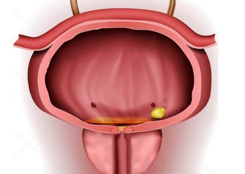 Tiểu buốt cuối bãi có kèm máu là bị làm sao, cách điều trị bệnh an toàn