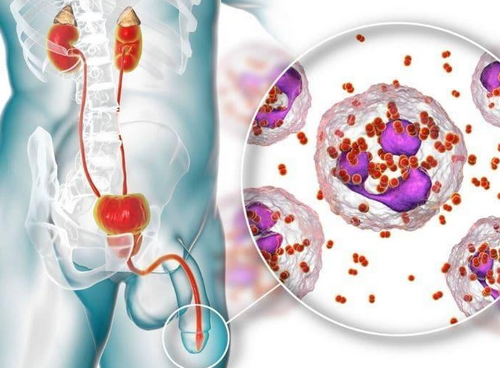 Tiểu buốt lẫn máu đau bụng trái và những vấn đề sức khỏe nam khoa