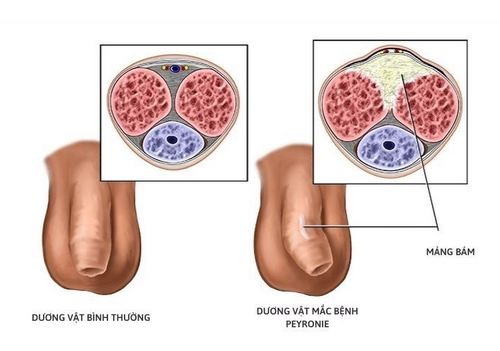 Tiểu rát đau quy đầu nổi hạch vùng kín ở nam giới