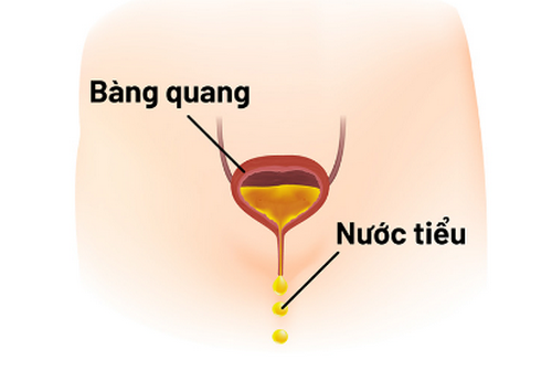 Tiểu són lắt nhắt nhỏ giọt là bị làm sao? Cảnh báo bệnh lý gì?