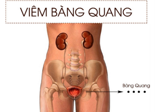 top-nguyen-nhan-gay-viem-bang-quang-va-cach-dieu-tri-hieu-qua