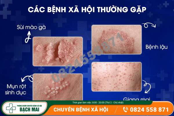 Các bệnh xã hội thường gặp hiện nay